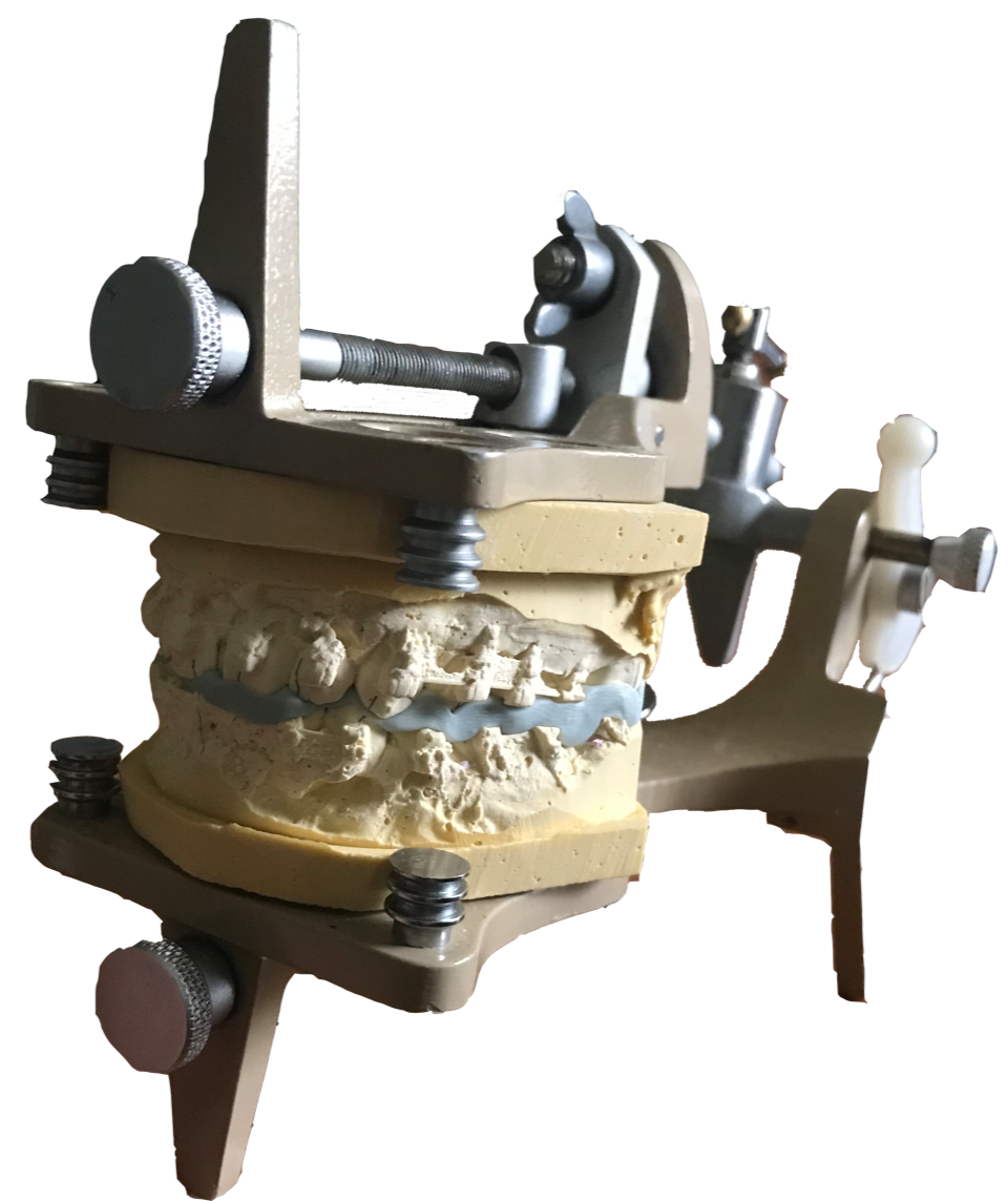 moulages montés sur un articulateur pour préparer la gouttière qui servira à la réalisation de
											la contraction mandibulaire