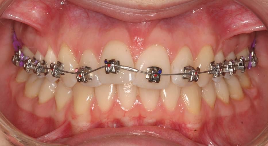 autre photo de traitement orthodontique classique pour chirurgie orthognatique