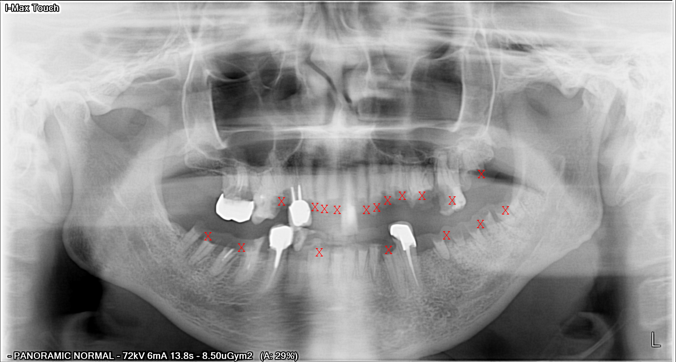 panoramique dentaire avec multiples dent nécessitant une avulsion dentaire