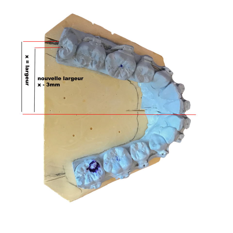 Contraction mandibulaire sur plâtre