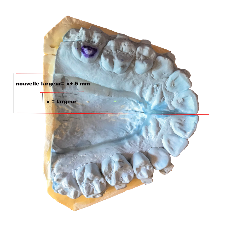 Disjonction maxillaire sur plâtre