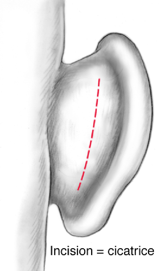 schéma de l'incision d'une otoplastie