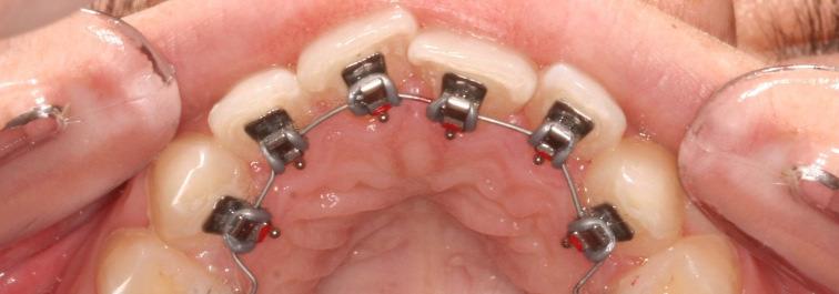 photo de traitement orthodontique lingual pour chirurgie orthognatique