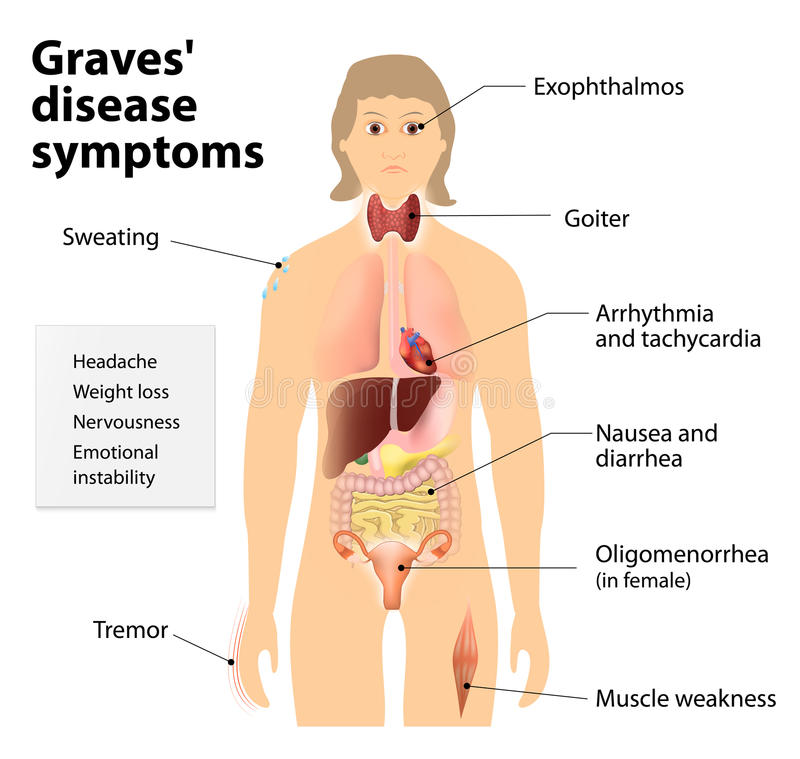 symptômes de la maladie de Basedow