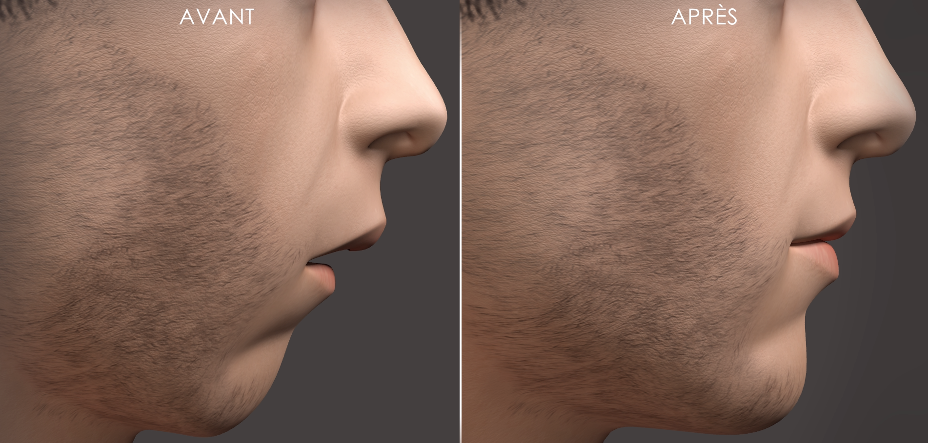 patient avant et après ostéotomie mandibulaire