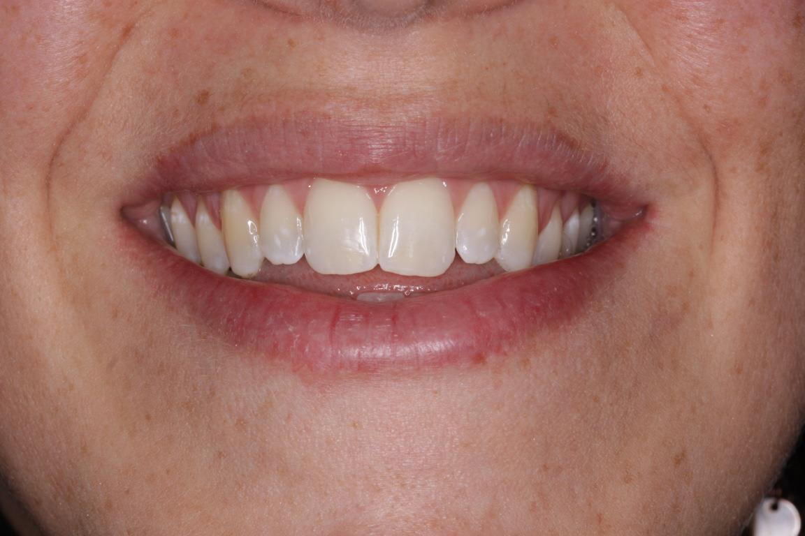 photo d'un résultat après orthodontie combinée à une chirurgie orthognatique